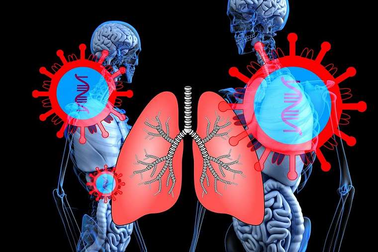 gambaran paru-paru saat terinfeksi corona © 2020 berbagai sumber